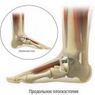 Плоскостопие: виды и причины