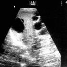 Поликистоз печени