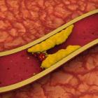 Повышенный холестерин: как бороться?