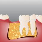 Преимущества метода имплантации зубов