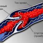 Причины и симптомы тромбоза