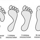 Причины и виды плоскостопия