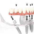 Протезирование метод all-on-4