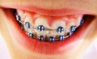 Протезирование при аномалиях зубов