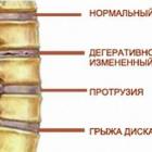 Протрузия дисков позвоночника