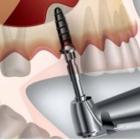 Синус-лифтинг – непростой метод восстановления зубного ряда