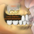 Синус-лифтинг при восстановлении зубного ряда