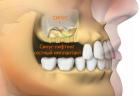 Синус-лифтинг при восстановлении зубного ряда