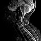 Спондилез – следствие старения организма