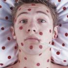 Ветряная оспа