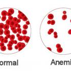 Виды анемии