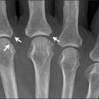 Виды артрита