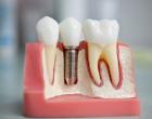 Виды имплантации зуба