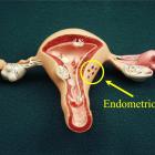 Внутренний и наружный эндометриоз