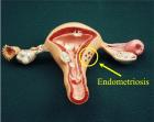 Внутренний и наружный эндометриоз