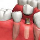 Восстановление целостности зубов