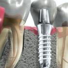 Восстановление зубов при помощи имплантации