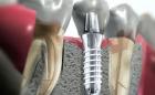 Восстановление зубов при помощи имплантации