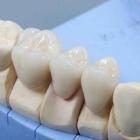 Зубное протезирование без проблем