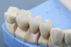 Зубное протезирование без проблем